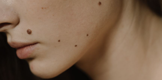 Can Vaseline Remove Skin Tags? What You Should Know