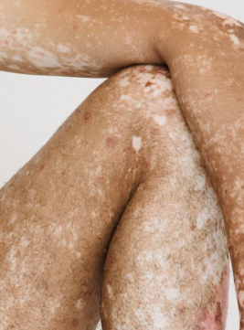Small White Spots on Your Skin? Here’s What They Could Mean